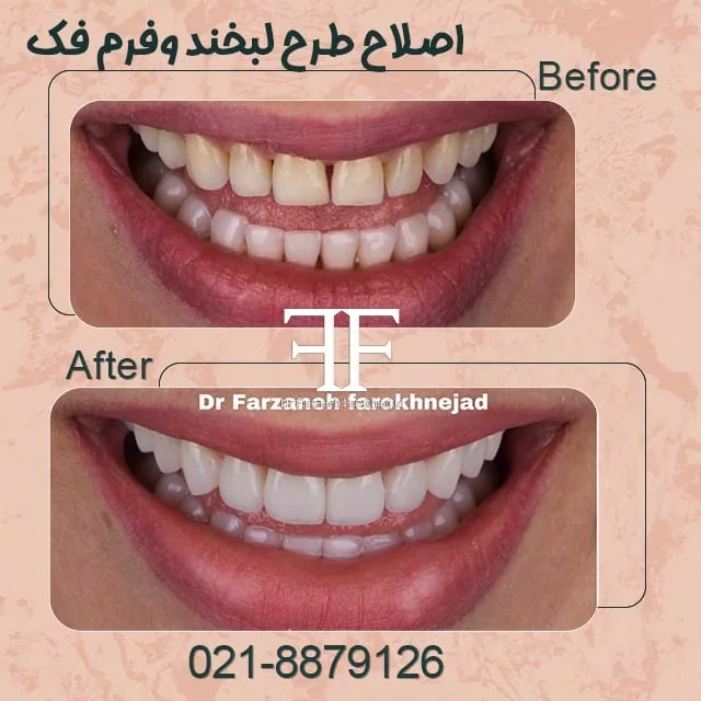 Provider-published dental treatment comparison from Dr. Farzaneh Farokhnejad Clinic, example 2