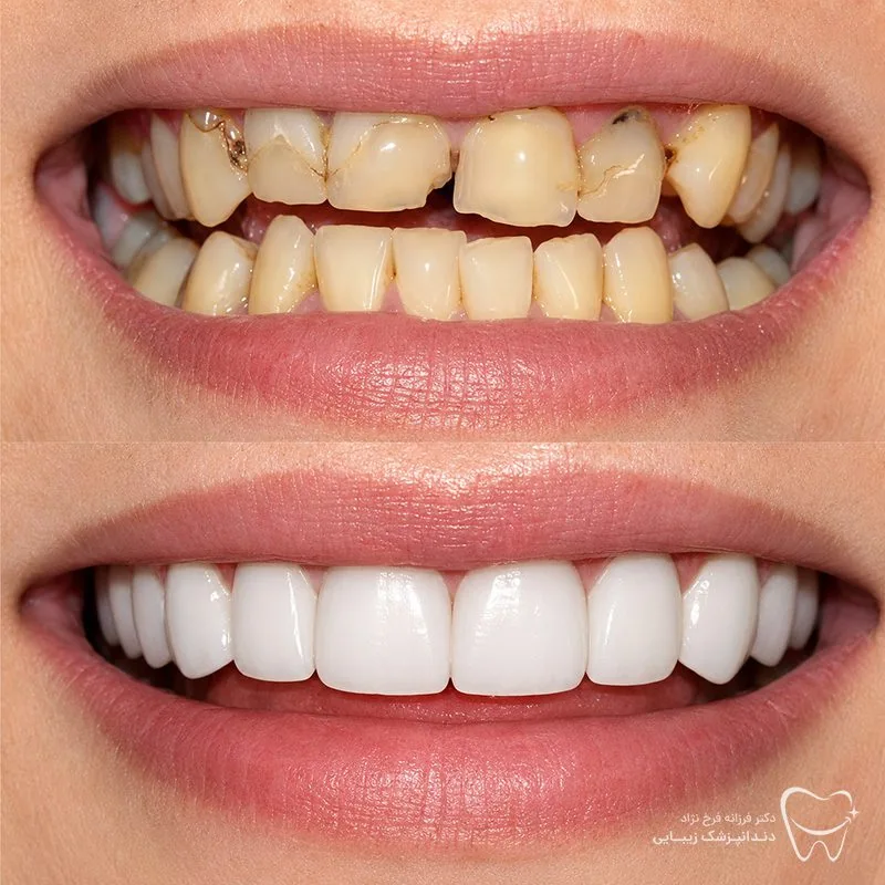 Provider-published dental treatment comparison from Dr. Farzaneh Farokhnejad Clinic, example 4