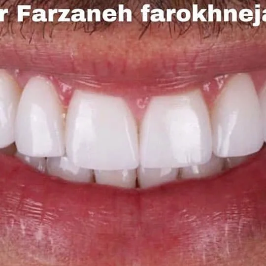 Published treatment result; matching before view not shown here from Dr. Farzaneh Farokhnejad Clinic, example 5