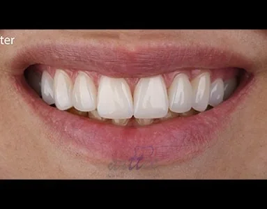 Provider-published dental treatment comparison from Dr. Saeed Karimi Clinic, example 1