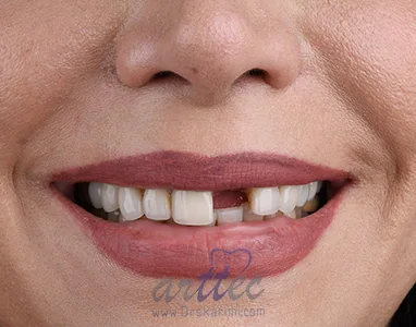 Provider-published dental treatment comparison from Dr. Saeed Karimi Clinic, example 3