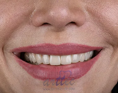 Provider-published dental treatment comparison from Dr. Saeed Karimi Clinic, example 4