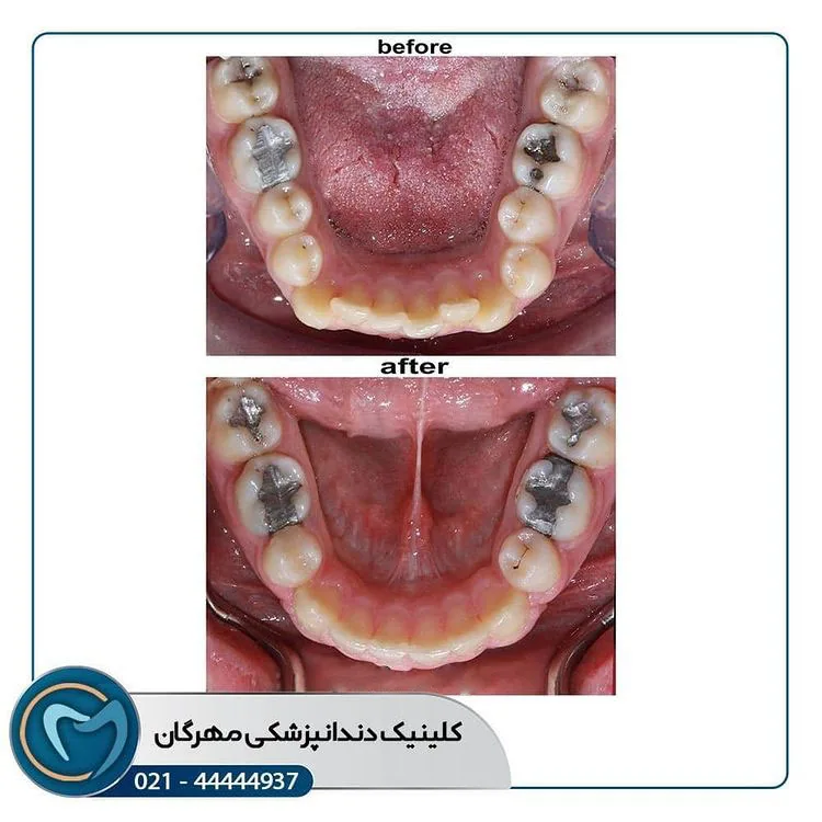 Provider-published dental treatment comparison from Mehregan Dental Center, example 1