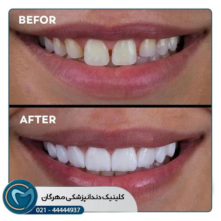 Provider-published dental treatment comparison from Mehregan Dental Center, example 2