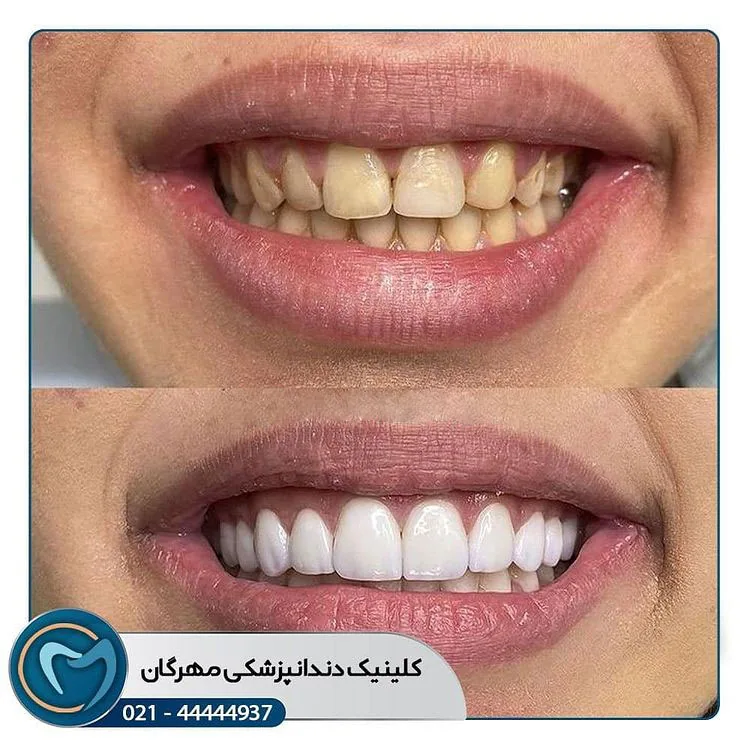 Provider-published dental treatment comparison from Mehregan Dental Center, example 3