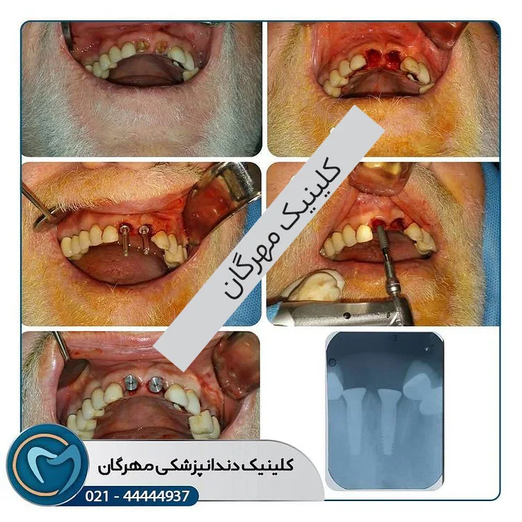 Provider-published dental treatment comparison from Mehregan Dental Center, example 4
