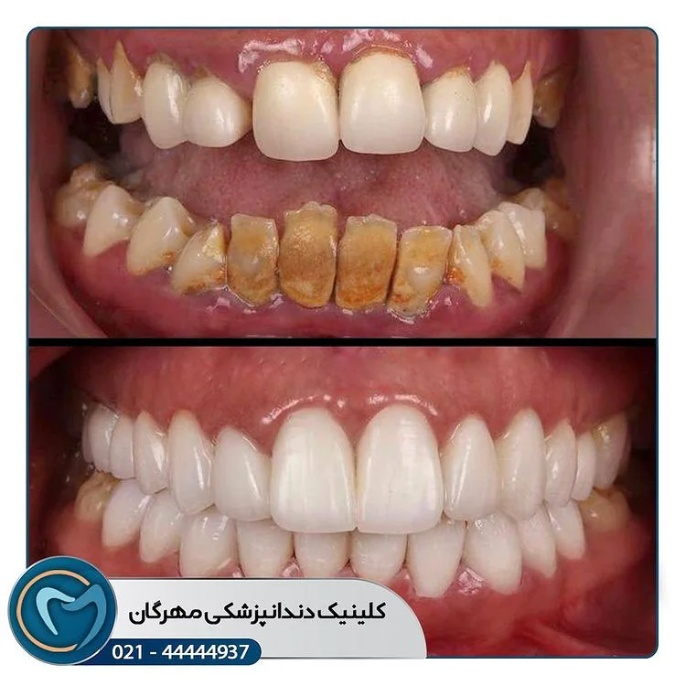 Provider-published dental treatment comparison from Mehregan Dental Center, example 5