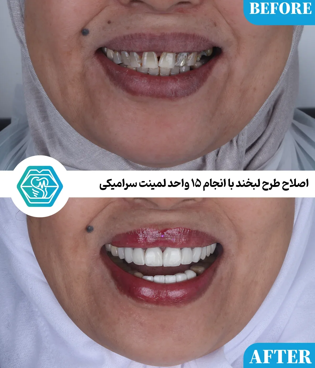 Provider-published dental treatment comparison from Negin Dental Clinic, Shiraz, example 3