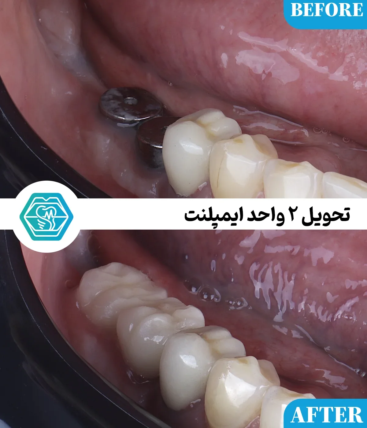 Provider-published dental treatment comparison from Negin Dental Clinic, Shiraz, example 5