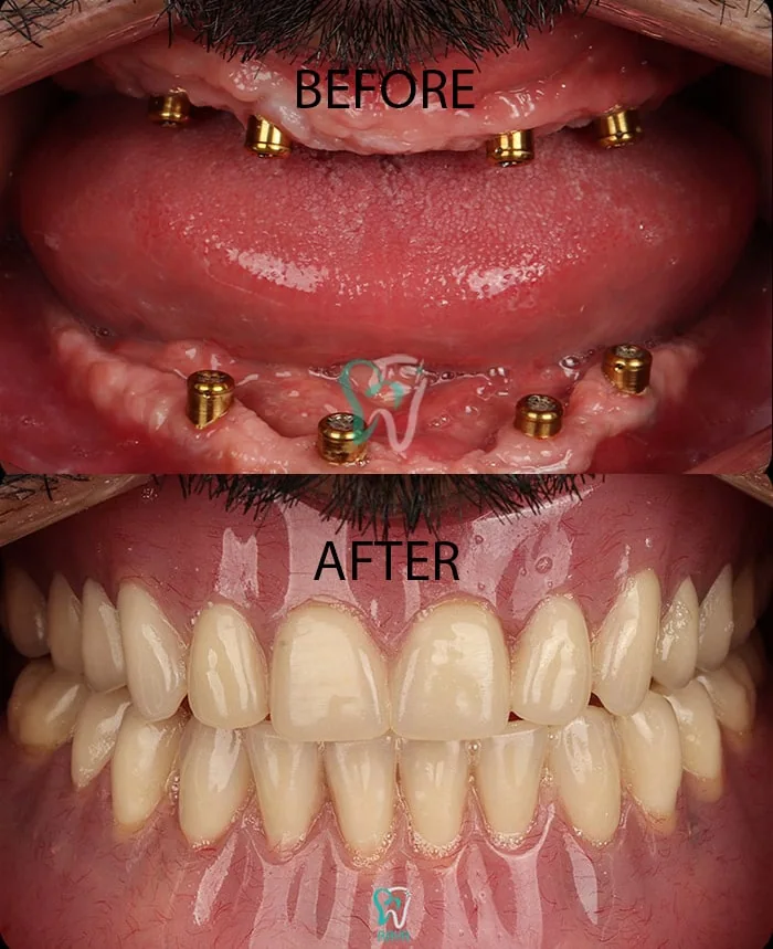 Provider-published dental treatment comparison from Raya Dental Center, example 1