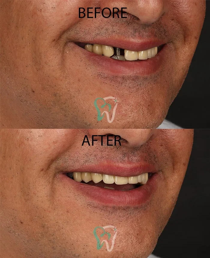Provider-published dental treatment comparison from Raya Dental Center, example 2