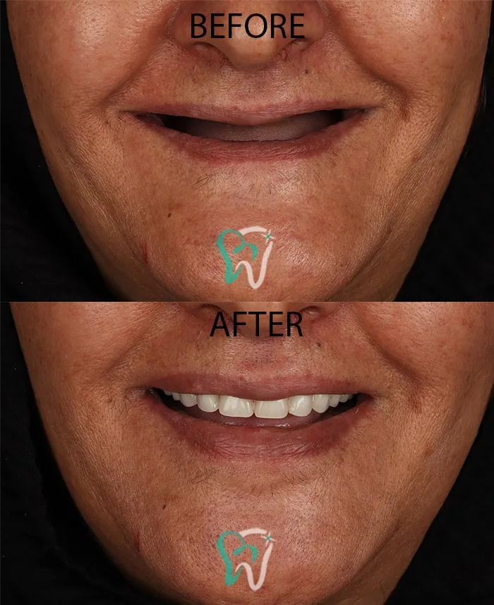 Provider-published dental treatment comparison from Raya Dental Center, example 3