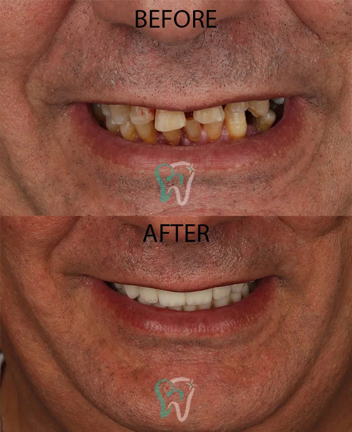 Provider-published dental treatment comparison from Raya Dental Center, example 4
