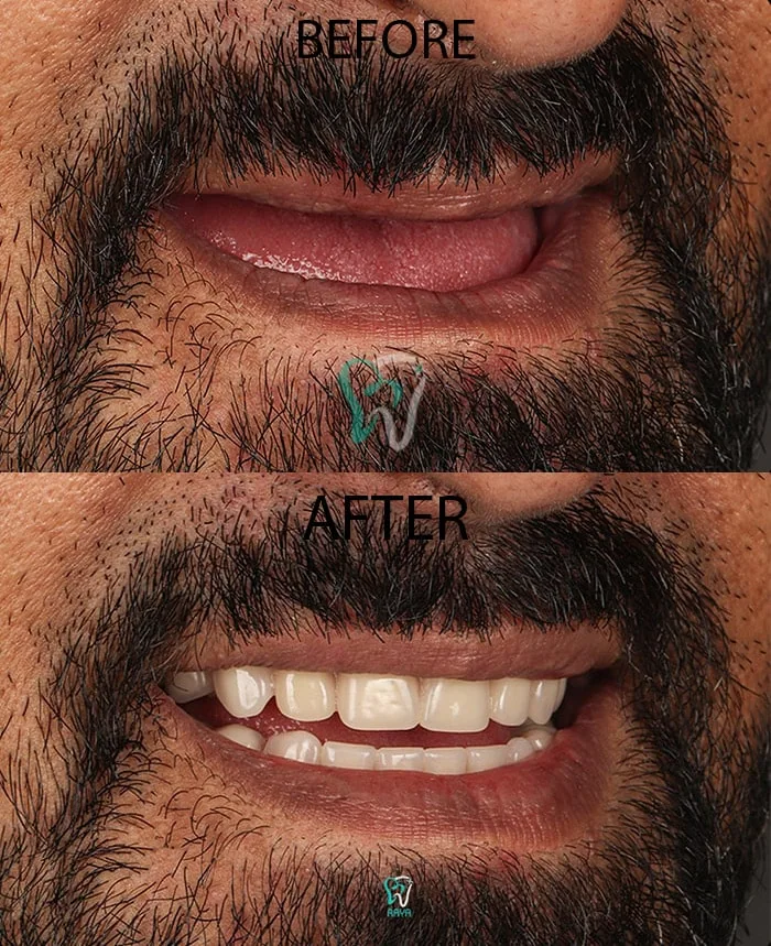 Provider-published dental treatment comparison from Raya Dental Center, example 5
