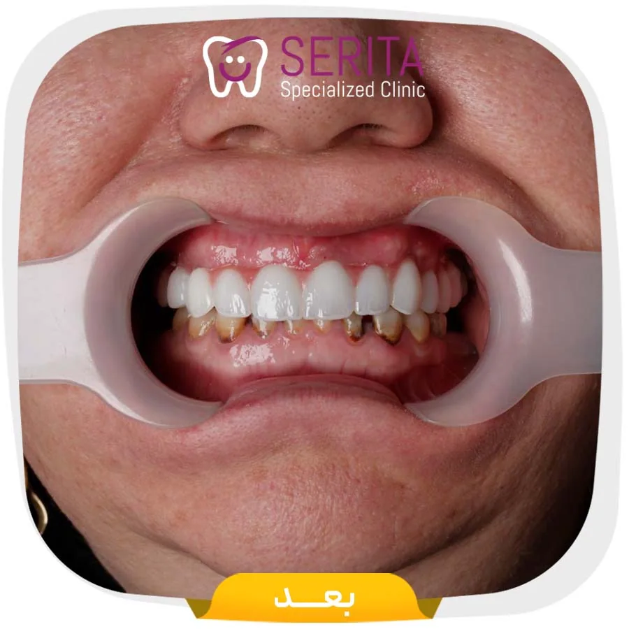 Provider-published dental treatment comparison from Serita Dental Center, example 3