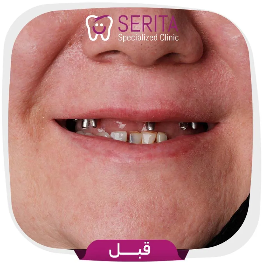 Provider-published dental treatment comparison from Serita Dental Center, example 4