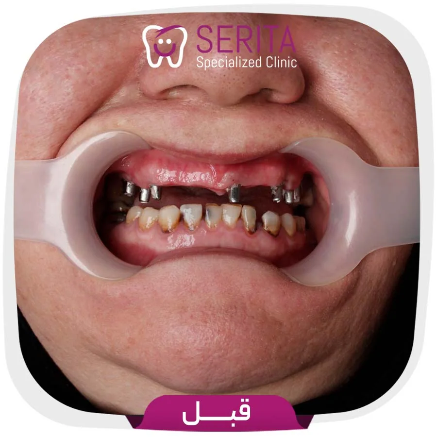 Provider-published dental treatment comparison from Serita Dental Center, example 5