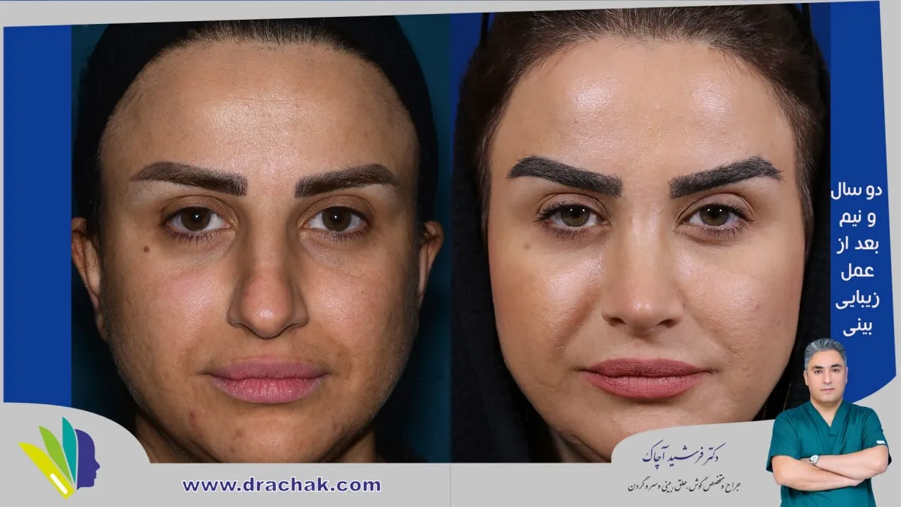 Provider-published rhinoplasty comparison image 5 from Dr. Farshid Achak