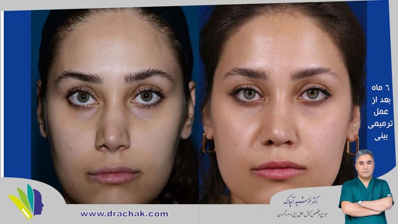 Provider-published rhinoplasty comparison image 4 from Dr. Farshid Achak