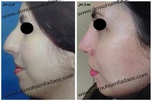 Provider-published rhinoplasty comparison image 1 from Dr. Mohsen Fadaei Araghi