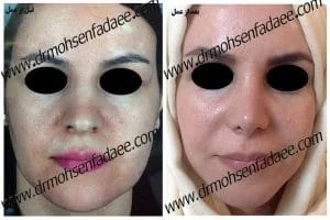 Provider-published rhinoplasty comparison image 2 from Dr. Mohsen Fadaei Araghi