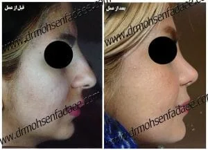 Provider-published rhinoplasty comparison image 3 from Dr. Mohsen Fadaei Araghi