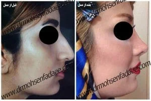 Provider-published rhinoplasty comparison image 4 from Dr. Mohsen Fadaei Araghi
