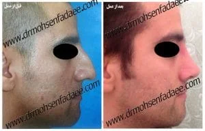 Provider-published rhinoplasty comparison image 5 from Dr. Mohsen Fadaei Araghi