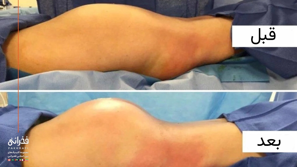 Brazilian butt lift before and after example published by Fakhraei Clinic