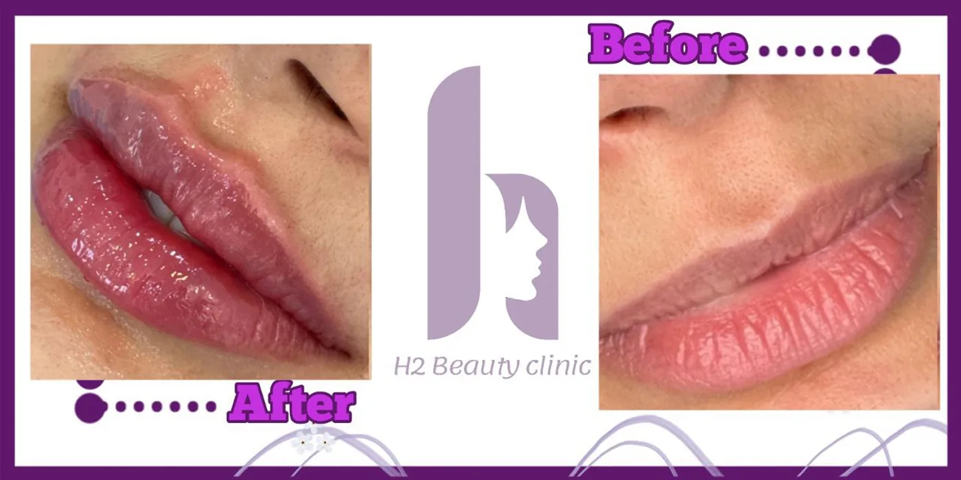 Provider-published before and after lip filler comparison 1 from H2 Clinic