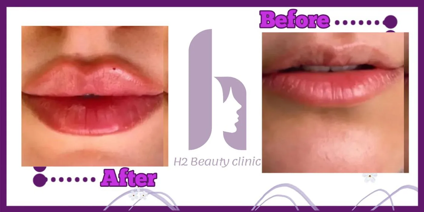 Provider-published before and after lip filler comparison 4 from H2 Clinic