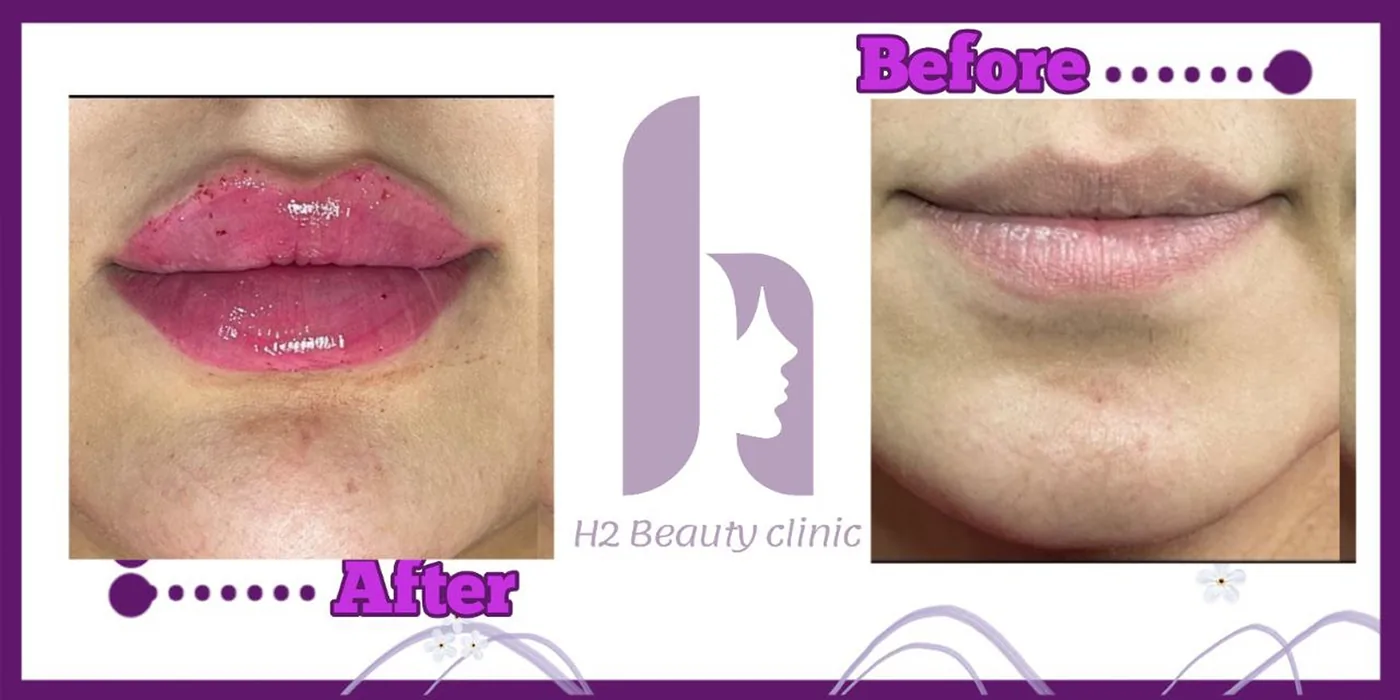 Provider-published before and after lip filler comparison 5 from H2 Clinic