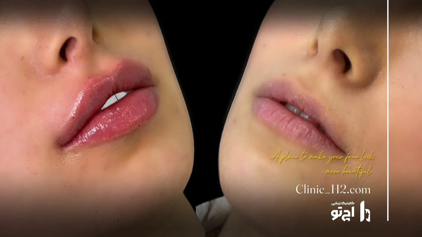 Provider-published before and after lip filler comparison 6 from H2 Clinic