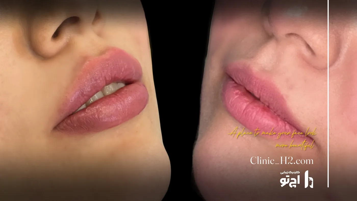Provider-published before and after lip filler comparison 7 from H2 Clinic