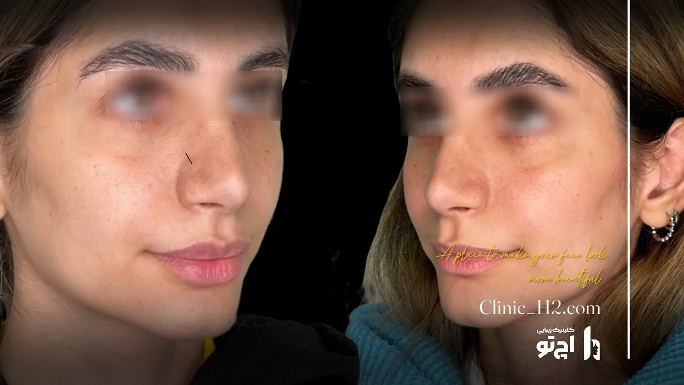 Provider-published before and after lip filler comparison 8 from H2 Clinic