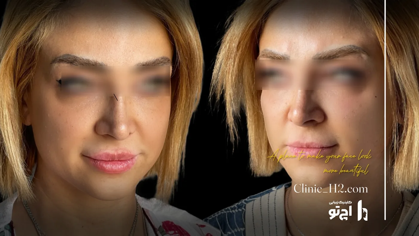 Provider-published before and after lip filler comparison 9 from H2 Clinic