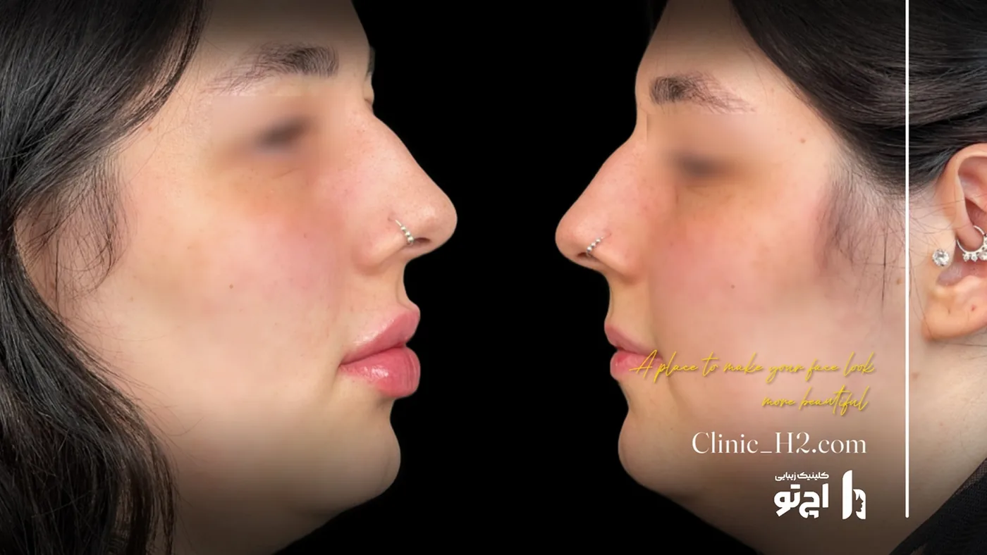 Provider-published before and after lip filler comparison 10 from H2 Clinic
