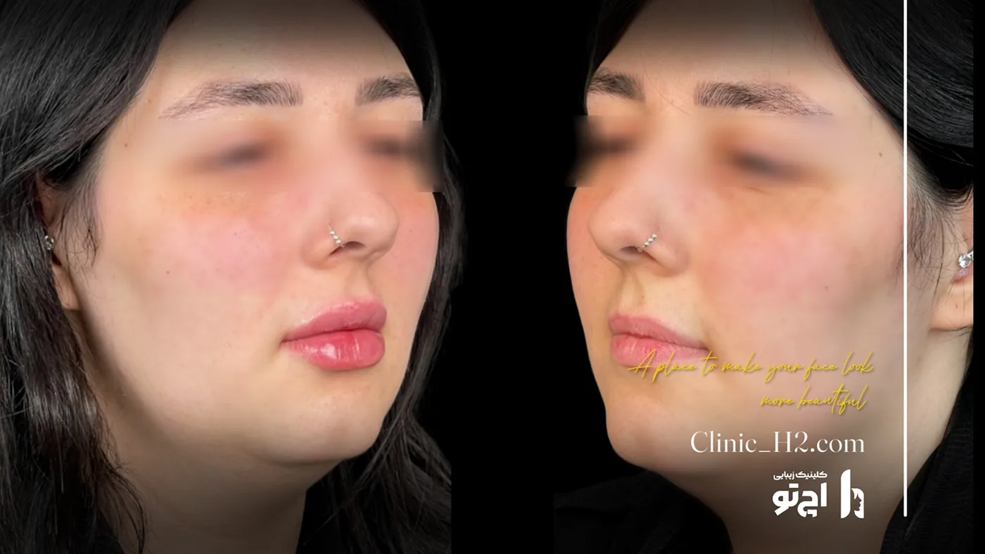 Provider-published before and after lip filler comparison 11 from H2 Clinic