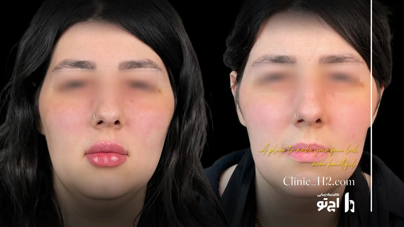 Provider-published before and after lip filler comparison 12 from H2 Clinic