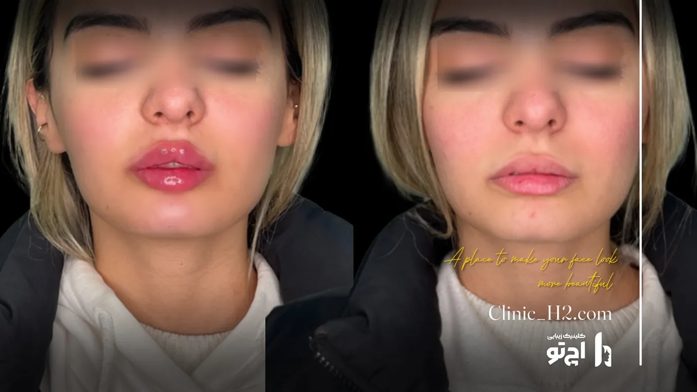 Provider-published before and after lip filler comparison 13 from H2 Clinic