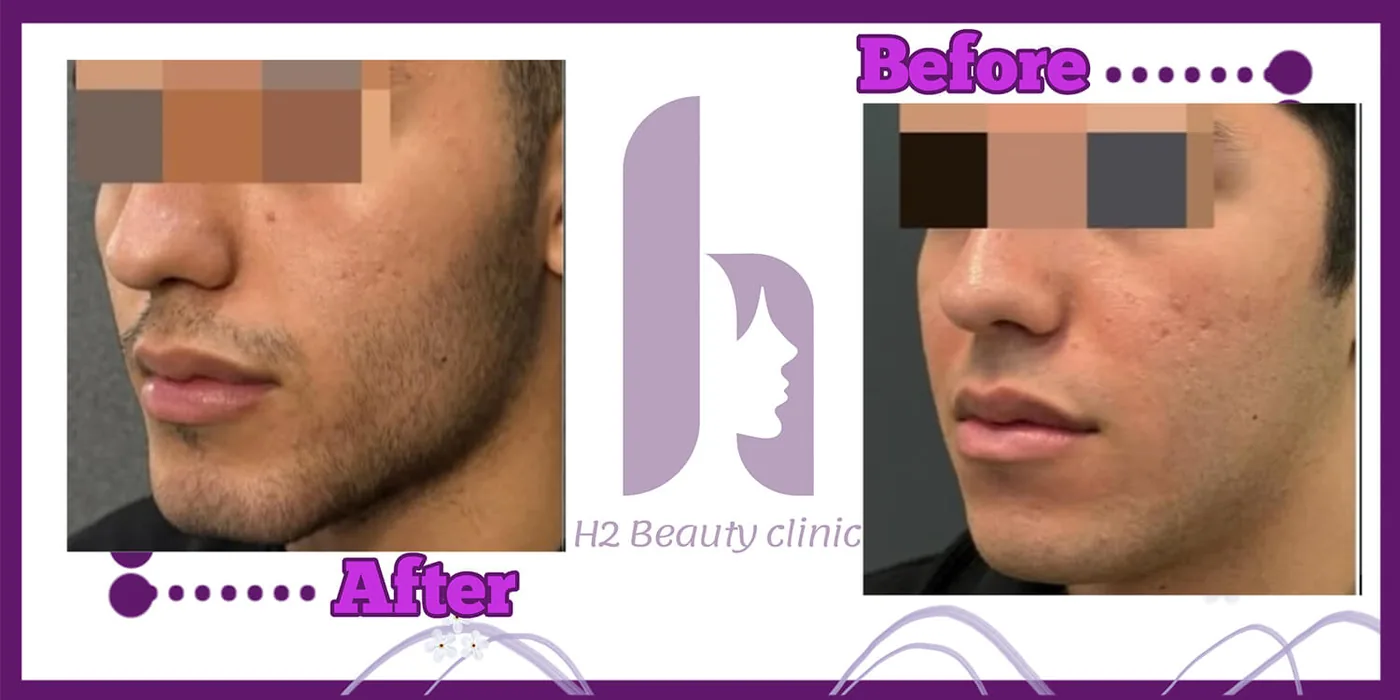 Provider-published before and after facial filler comparison 14 from H2 Clinic