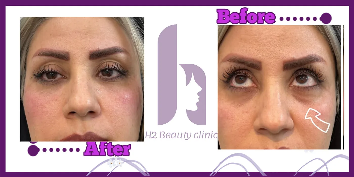 Provider-published before and after facial filler comparison 15 from H2 Clinic