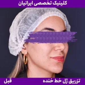 Before smile line filler, Iranian Clinic comparison 1