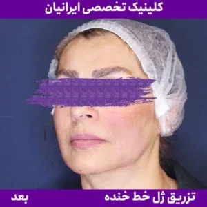 After smile line filler, Iranian Clinic comparison 3