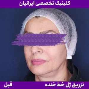 Before smile line filler, Iranian Clinic comparison 3