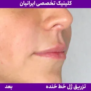 After smile line filler, Iranian Clinic comparison 4