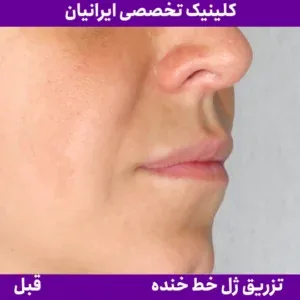 Before smile line filler, Iranian Clinic comparison 4