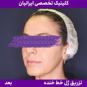 After smile line filler, Iranian Clinic comparison 5
