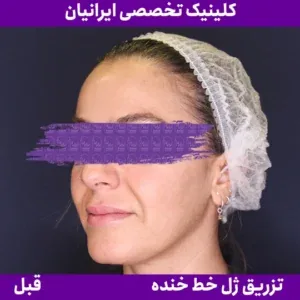 Before smile line filler, Iranian Clinic comparison 5