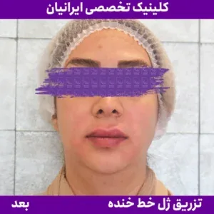 After smile line filler, Iranian Clinic comparison 6